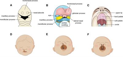 Dental caries and periodontitis risk factors in cleft lip and palate patients